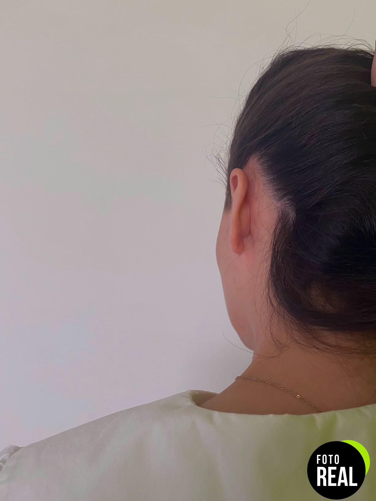 otostick-corrector-orejas-8-foto-2