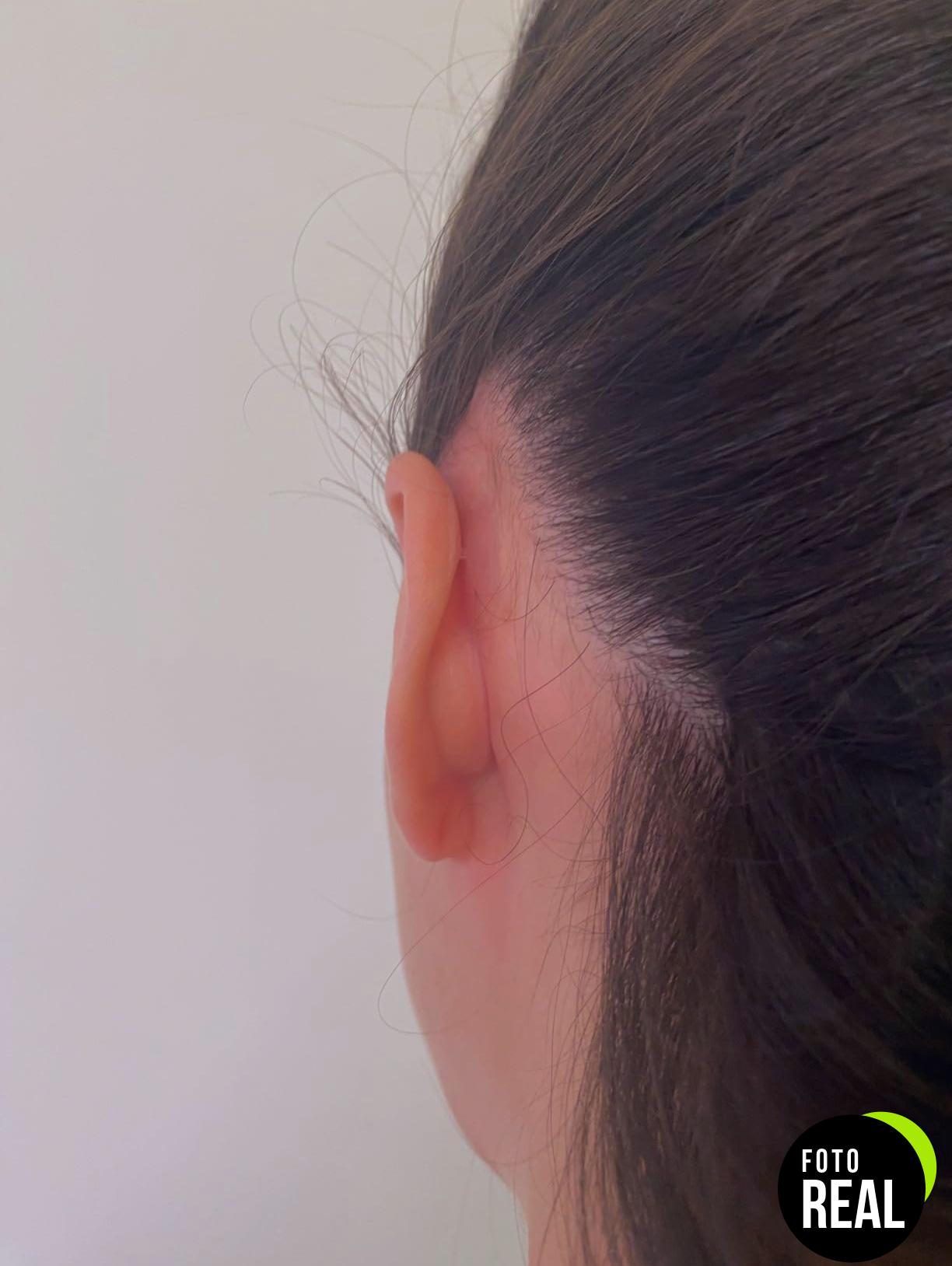 otostick-corrector-orejas-8-foto-3