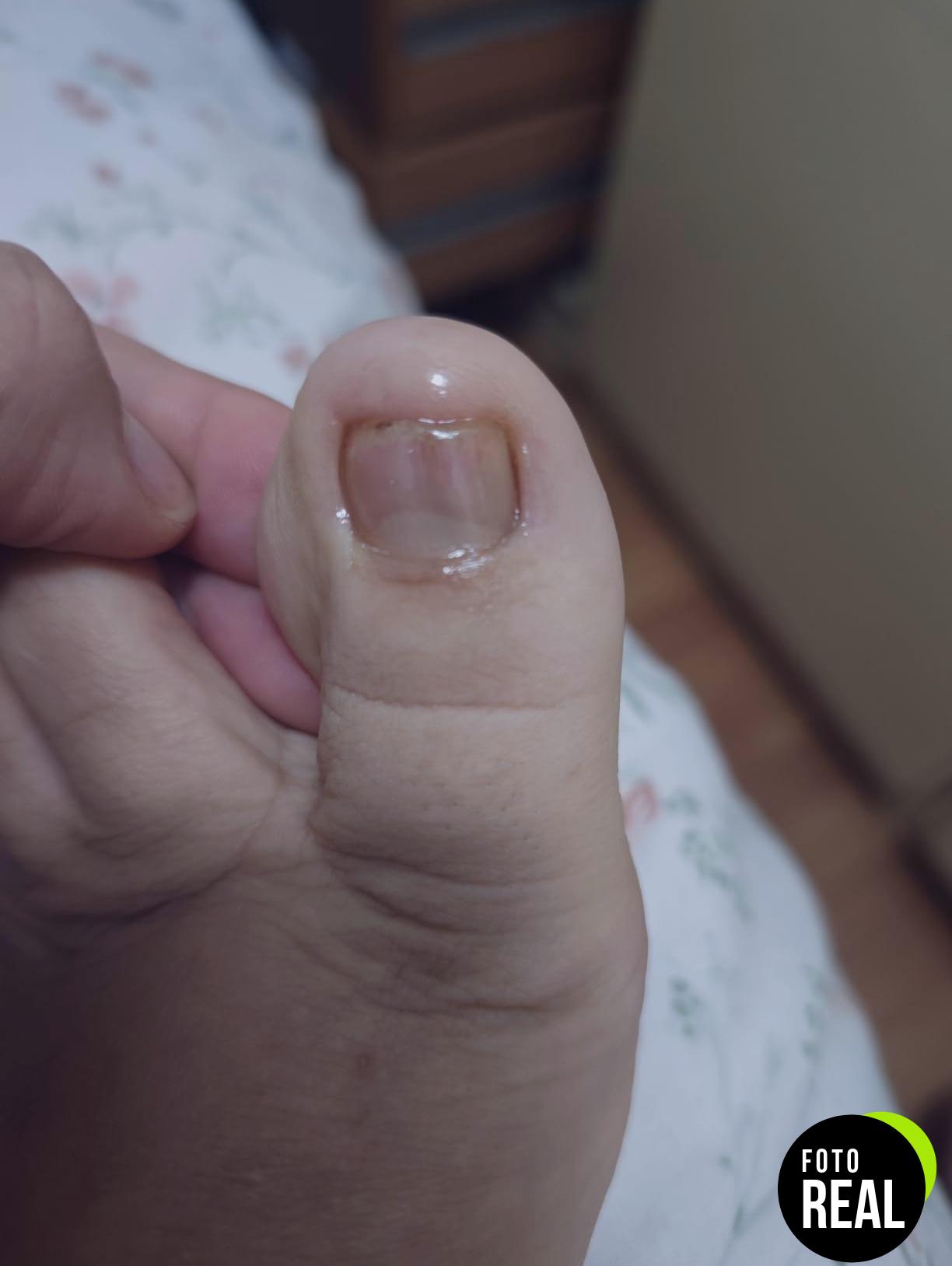 poderm-tratamiento-hongos-unas-pies-suiza-foto-1