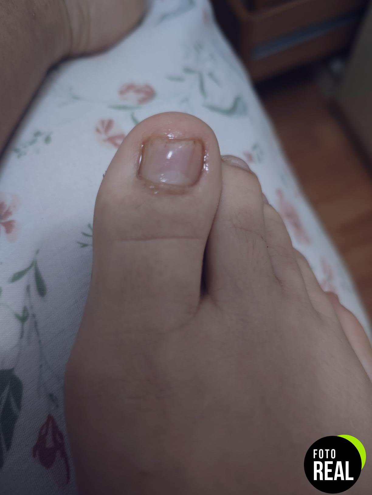 poderm-tratamiento-hongos-unas-pies-suiza-foto-2