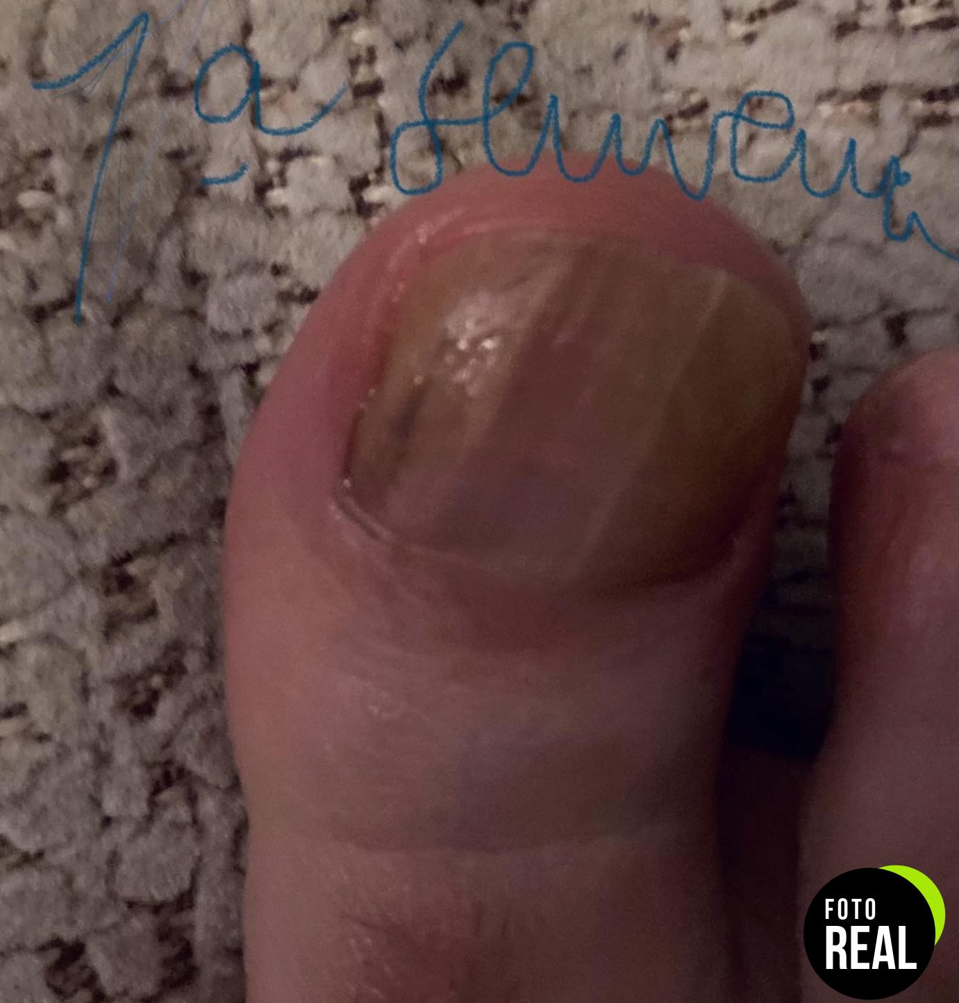 poderm-tratamiento-hongos-unas-pies-suiza-foto-3